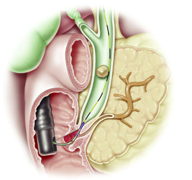 ERCP Figure 2