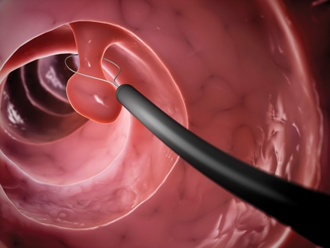 colorectal colonoscopy polyps full view