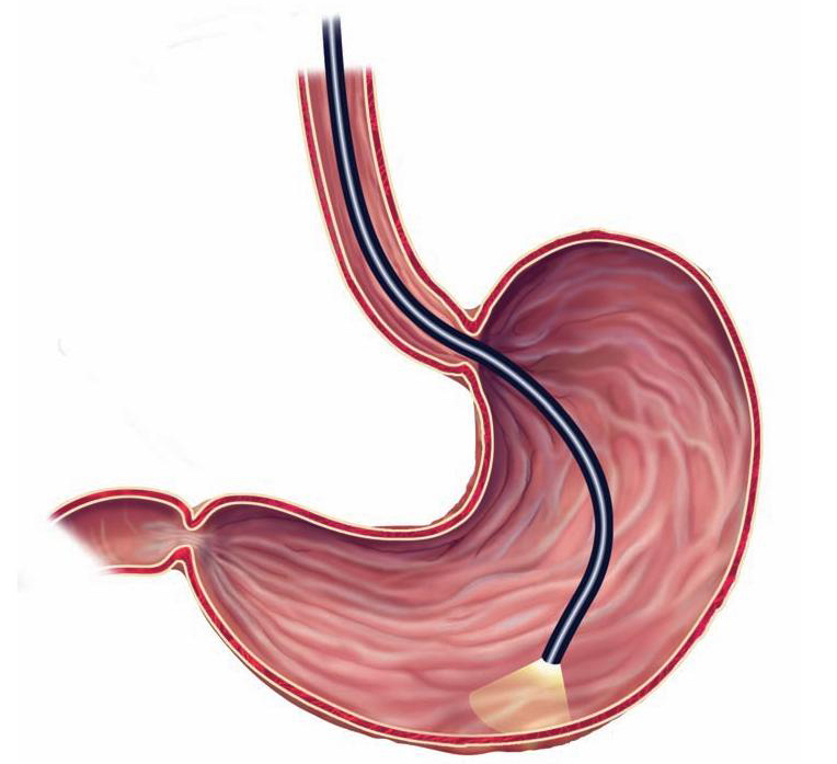 Upper Endoscopy 1