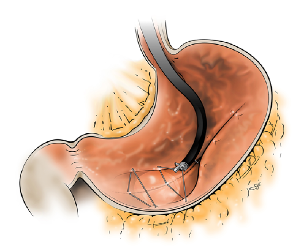 endosleeve : les points du suture