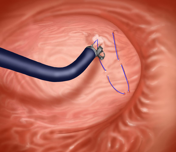 endosleeve : les points de suture